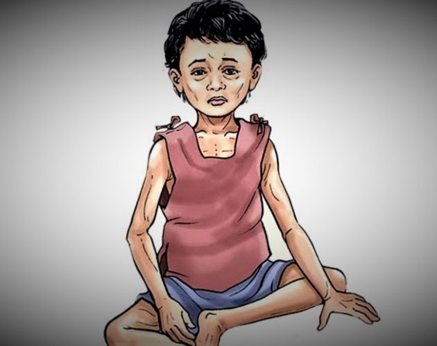 देशभर पोषण परीक्षण गर्दा बढी भेटिए कुपोषित बालबालिका